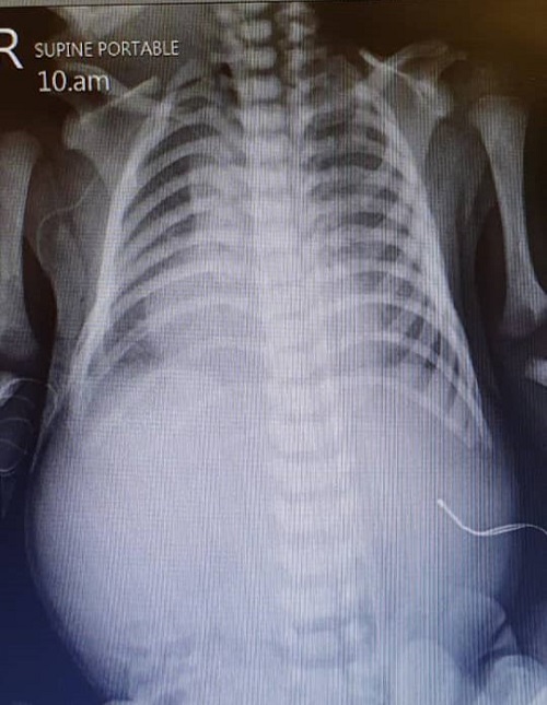 CASES OF THE WEEK – “Rare case of male baby with Down syndrome & duodenal atresia (antenatal finding) & operated at 26 hours of life” by Dr Wissam AlTamr, Specialist Paediatric Surgery 02